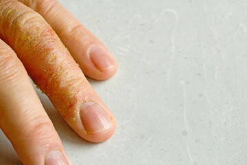 Closeup of Eczema Dermatitis on man hand and fingers. Skin peeling,desquamation of hand, gray modern background. Hand dermatitis, eczema. Finger problem, allergy. Copy space for your text