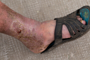 Foot ulcer