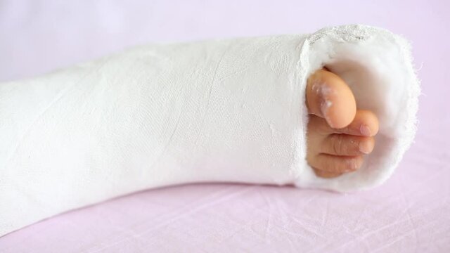Leg in plaster of a teenage girl on a pink bed after an accidental fall with an ankle fracture.Fracture of the lower leg in a child
