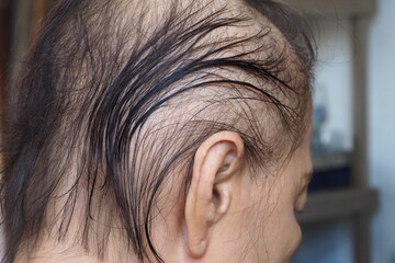 Side view of an old Asian woman having hair fall problems during her chemotherapy course - obrazy, fototapety, plakaty