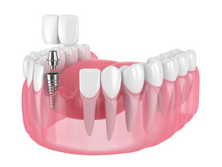 3d render of jaw with dental incisor cantilever bridge