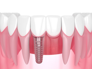3d render of jaw with dental incisor cantilever bridge