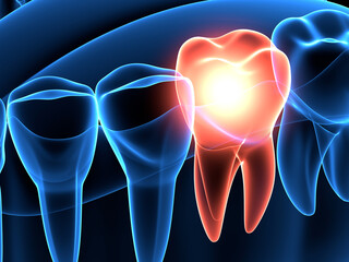 3d render of  jaw x-ray with aching tooth