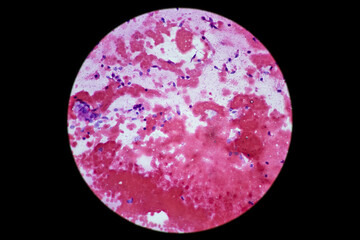 Squamous cell carcinoma of the lung is a type of lung cancer. It occurs when abnormal lung cells multiply out of control and form a tumor. 