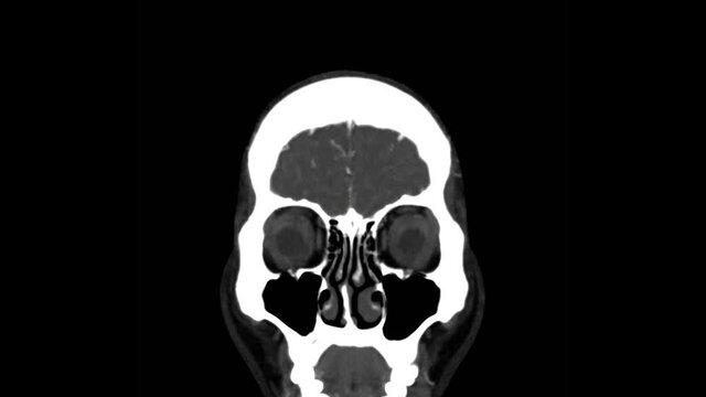 Computed Tomography Angiography of Brain in coronal view.