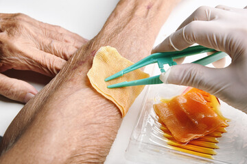 Wound dressing, Doctor cleaning and wash infected wound in chronic senior diabetes patient with...