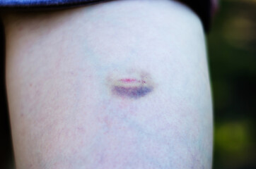 Fototapeta premium Close-up of a large bruise and scratch on a female foot. Photo for advertising medicines for bruises and bruises