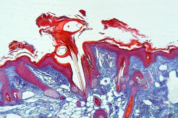 Human skin with a Scabies infection, Sarcoptes scabiei, under the microscope