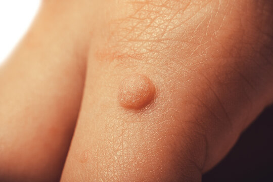 Common wart Verruca vulgaris a flat wart commonly found on the hand of children and adults. They are caused by a type of human papillomavirus HPV