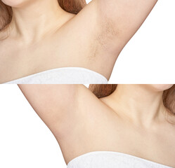 Girl underarm. White woman armpit. Before and after epilation collage. Wax depilation result...
