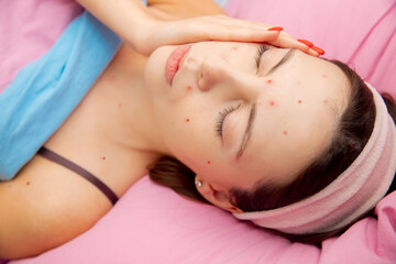 Young woman with chickenpox varicella virus, with face sadness in bed