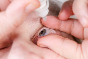 Human eye during the dripping with eye drops, close-up