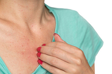A young woman with pimples on the skin of chest. The girl scratches the skin with an allergic rash on chest.