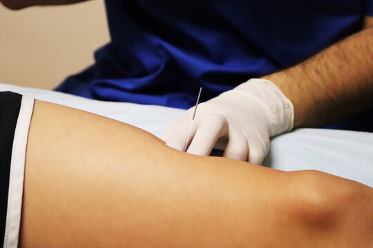 Holding the needle in place during the dry needle.