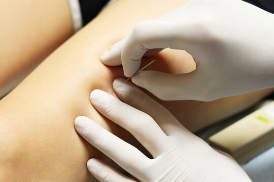 Holding the needle in site during dry needling.
