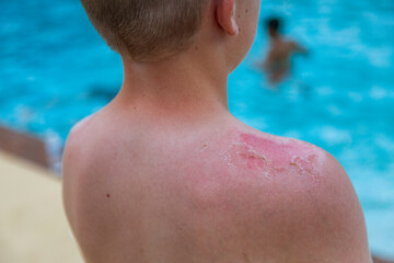 Close up of the sun burnt skin on a Young boy's shoulder. Selective focus on the dead peeling skin...