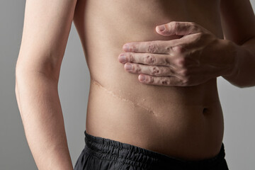 male perosn showing surgery scar after kidney pyelonephritis. after remove kidney operation. caucasian person close up over grey background. - obrazy, fototapety, plakaty