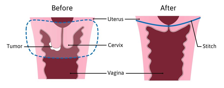 trachelectomy - surgery removal of the cervix. Medical vector illustration marked with lines. Before and after. Stitch, vagina, cervix, tumor, cancer
