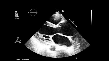 Image of the heart in gray-scale mode during transesophageal ultrasound.