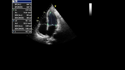 Image of the heart in gray-scale mode during transesophageal ultrasound.