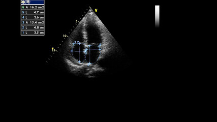 Image of the heart in gray-scale mode during transesophageal ultrasound.