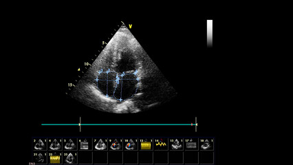 Image of the heart in gray-scale mode during transesophageal ultrasound.