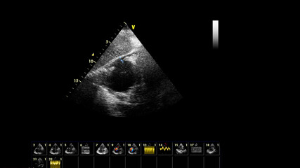 Image of the heart in gray-scale mode during transesophageal ultrasound.
