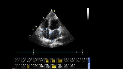 Image of the heart in gray-scale mode during transesophageal ultrasound.