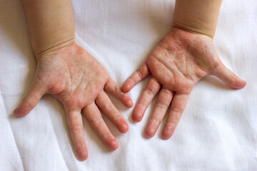 Red rash on the hands of the palms of the child, rubella scarlet fever Coxsackie and other...
