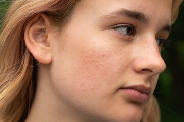 Problematic skin. Acne and red festering pimples on the face of a young girl. Facials for teen...