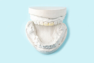 Stomatologic plaster cast, molds of human jaws and teeth on blue background. Dental casting gypsum for manufacture of dentures, braces or false teeth. Dentistry and orthodontics concept. © Elena