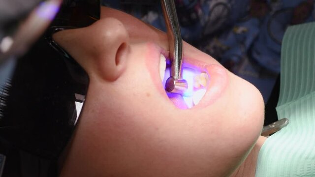 Applying resin based composite filling on tooth and curing it with LED. Young woman at dental clinic. Female dentist with assistant treating cavities in a patient mouth in modern dental office.