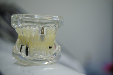 Mock up a sample of the upper and lower jaw in the dentist's office.