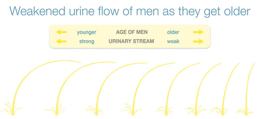 Obraz premium Weakened urinary flow of men as they get older. Urine stream samples of young and old men with strong an weak urinary stream as an indicator of enlarged prostate. 