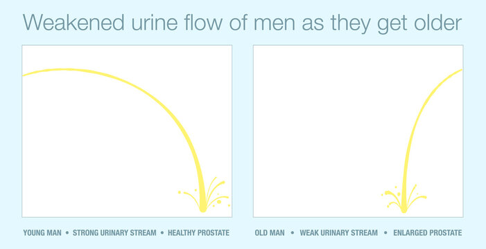Strong urine stream of young man with healthy prostate and stream of old man with enlarged prostate in comparison. Weakened urinary flow of men as they get older. Vector illustration.
