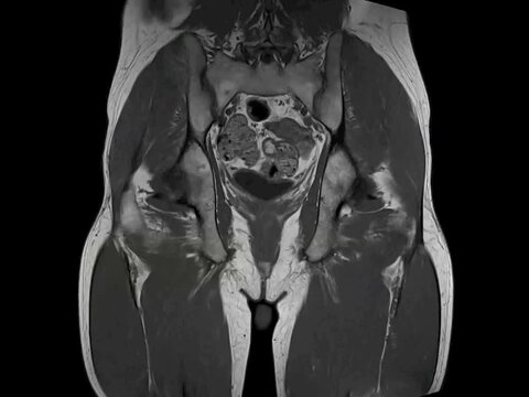 Osteonecrotic hips, MRI scan