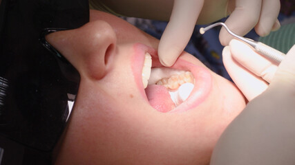 Applying resin based composite filling on tooth. Young woman at dental clinic. Female dentist with assistant treating cavities in a patient mouth in modern dental office. - 363118007