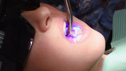 Applying resin based composite filling on tooth and curing it with LED. Young woman at dental clinic. Female dentist with assistant treating cavities in a patient mouth in modern dental office.