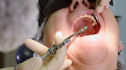 Dentist making local anaesthesia shot before surgery. Senior woman at dental clinic. Dentist with assistant install implant in a patient mouth in modern dental office - 363118497