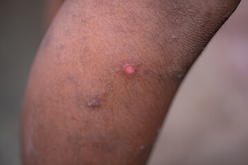 Fototapeta premium Many scars on the legs