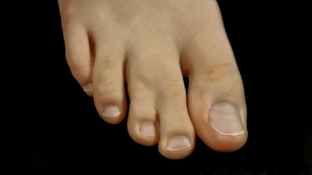 webbed digits