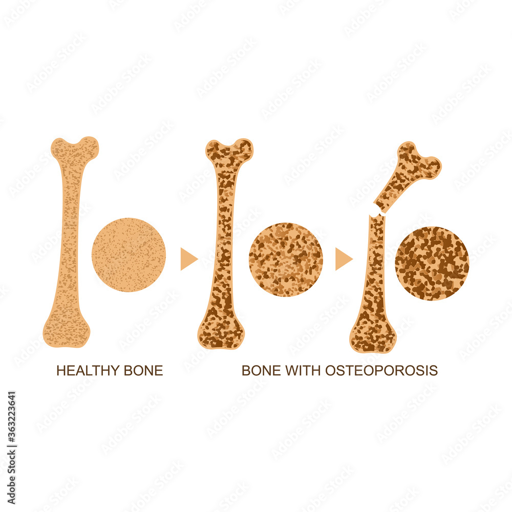 Canvas Prints Osteoporosis Bone Infographics Concept Card Poster. Vector