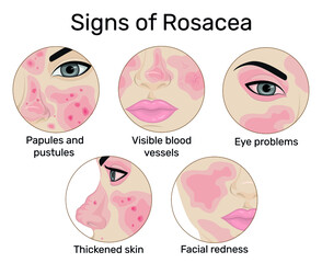 An illustration of the five signs of rosacea such as redness of the skin, papules and pustules, visible blood vessels, thickening of the skin, and eye problems