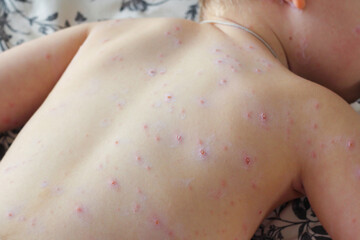 Naklejka premium Close-up of a small child with chickenpox virus or chickenpox bubble in a hurry