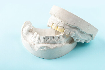Stomatologic plaster cast, molds of human jaws and teeth on blue background. Dental casting gypsum for manufacture of dentures, braces or false teeth. Dentistry and orthodontics concept. © Elena