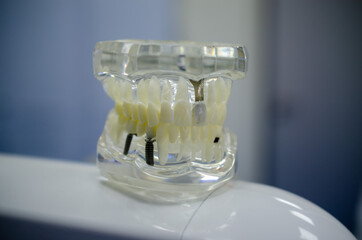 Mock up a sample of the upper and lower jaw in the dentist's office.