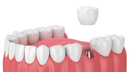 Jaw with dental implant placement over white background