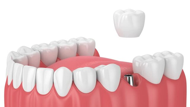 Jaw with dental implant placement over white background