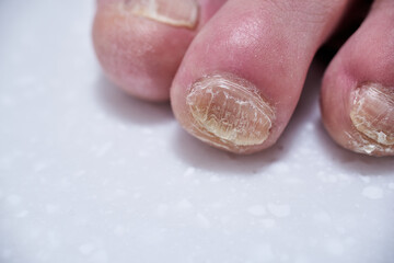 Male nails destroyed by onycholysis. Damage to the male foot nails. At the dermatologist doctor....