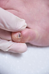 Podiatrist treating feet during procedure, examines the foot. Professional medical pedicure....
